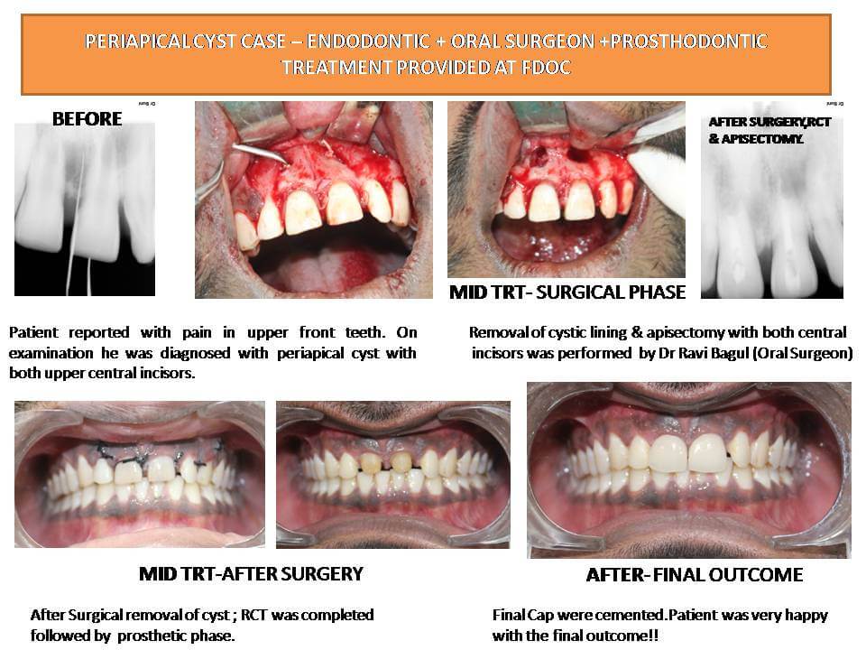 Wisdom Tooth Extraction in Pune